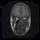 Fibrous dysplasia of the left maxillary sinus: MRI - Magnetic Resonance Imaging